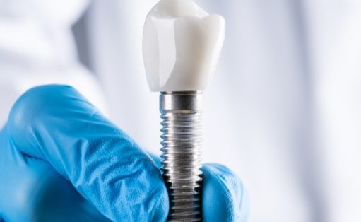 Why Should You Use Cylindrical Implants?