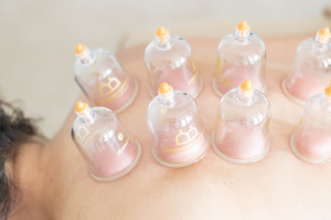 Chinese Cupping: An Ancient Therapy with Modern Health Benefits